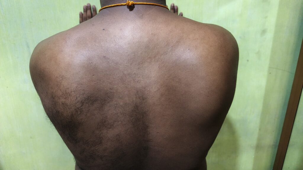 scapular dyskinesis